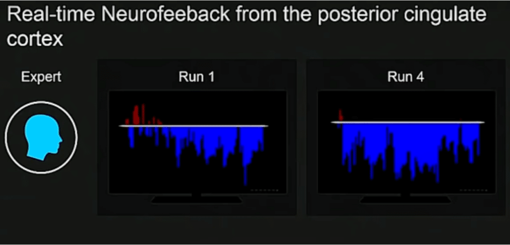 f-mri image of the real-time neurofeedback from the PCC in an expert meditator. On the left it shows a graph very few red graphical spikes a the beginning of a meditation segment with active blue spikes at the bottom  indicating that the PCC was deactivated.