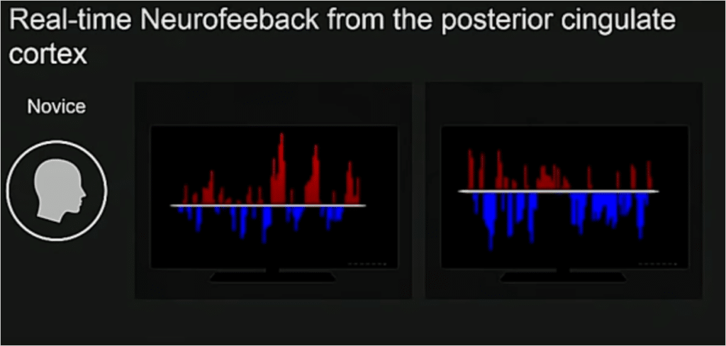 f-mri image of the real-time neurofeedback from the PCC in a novice meditator. On the left it shows a graph where the top is red graphical spikes and bottom is smaller blue graphical spikes indicating that the PCC was still active. 